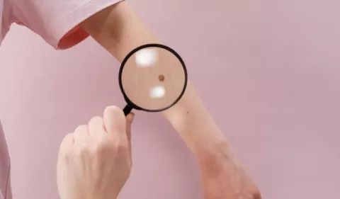 ¿Cómo prevenir el cáncer de piel?