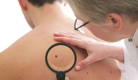Melanoma: ¡Pendientes de las señales de alerta!