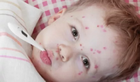 Consejos: ¿Cómo proteger a sus hijos de la varicela? 