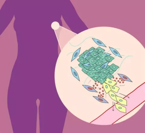 Un gen de las células que rodean los tumores, clave en el avance del cáncer de mama