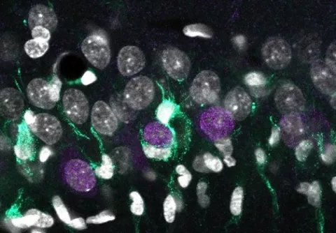 Un mapa genómico da claves para entender la epilepsia del lóbulo temporal