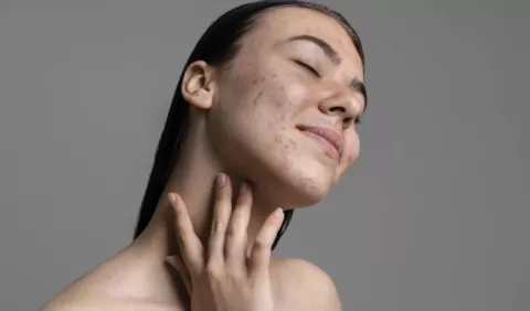 Melasma: ¿Qué es y cómo combatirlo?