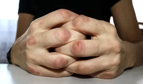 Artritis psoriásica, un mal que afecta la piel y las articulaciones