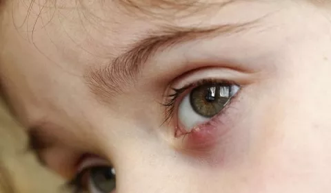 Orzuelos, ¿por qué aparecen en los ojos?