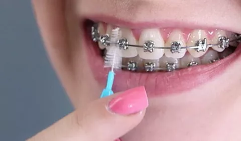 Causas de la caída de 'brackets' : ¿Qué hacer?