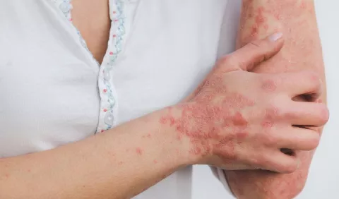 Lucha contra la psoriasis, una dolencia que afecta física y psicológicamente a los pacientes