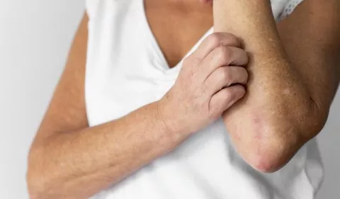 Herpes zóster: ¿Cómo prevenir las secuelas?