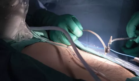 Beneficios de la cirugía sin huella para los pacientes