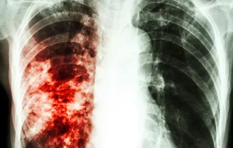 ¿Qué es la tuberculosis  drogorresistente y cómo se trata en Panamá?