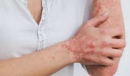 ¡Atención! Más de 80 mil personas sufren de psoriasis en Panamá