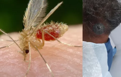 ¡Cuidado! Una picadura de chitra o jején podría causarle leishmaniasis, cuyos casos han subido