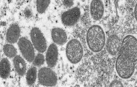 ¿Cómo evitar contraer la viruela del mono y quiénes corren más riesgo de morir?