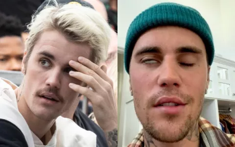 Justin Bieber sufre el síndrome de Ramsay Hunt: ¿En qué consiste y cuáles son los síntomas?