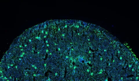 Identifican un nuevo marcador para el lupus