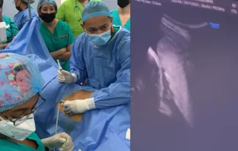 Caja de Seguro Social realiza con éxito primera transfusión fetal intrauterina, ¿en qué consistió?