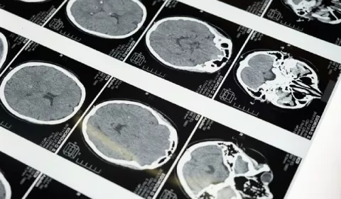 Tumor cerebral: ¡Señales de alerta!