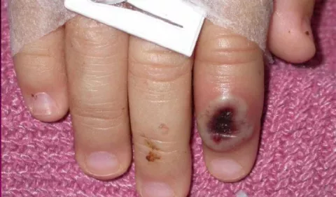 ¿Qué sabe Panamá del primer caso de viruela símica o viruela del mono detectado en el país?