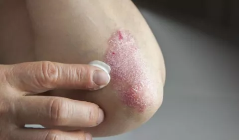 Panamá declara de interés nacional la investigación y atención integral de la psoriasis