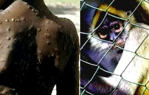 ¡En aumento! Ya son cuatro los casos confirmados de viruela del mono en Panamá