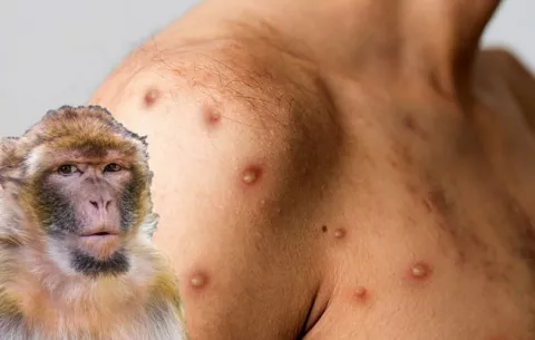 Panamá confirma su tercer caso de la viruela del mono