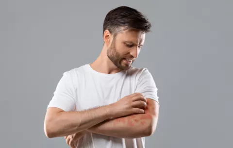 Dermatitis Atópica: ¿Qué cuidados recomiendan a los pacientes con esta enfermedad? 