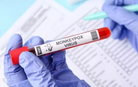 Minsa confirma dos nuevos casos de viruela del mono, cifra  aumenta a 16