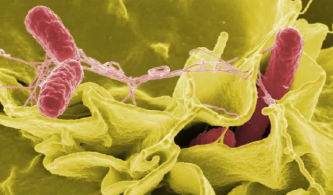 Sepsis, afección que puede ocasionar un daño irreversible