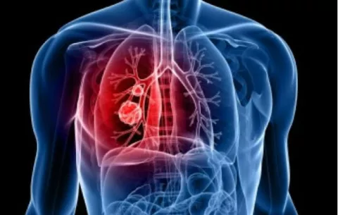 Cáncer de pulmón: Aliados en la lucha contra esta enfermedad