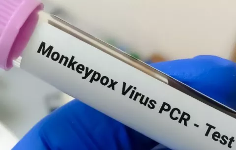Panamá reporta siete nuevos casos de la viruela del mono, ya suman 34