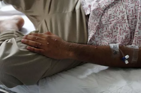  Panamá ha aplicado 33 vacunas contra la viruela símica 