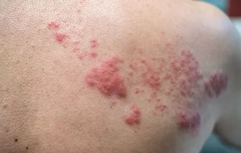 Herpes zóster: ¿Influye el estrés en el aumento de casos?