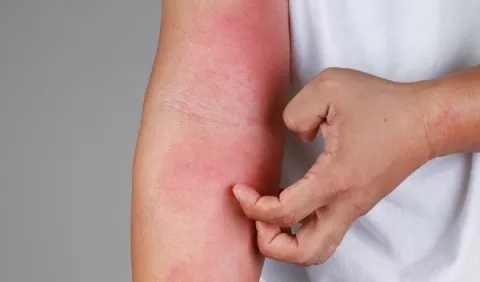 Dermatitis atópica, una condición poco comprendida