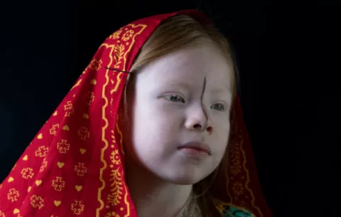 Experta de la ONU evaluará derechos de los albinos en Panamá