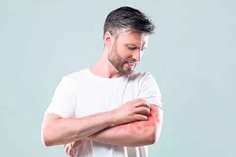 Estrés y dermatitis atópica: Factores desencadenantes