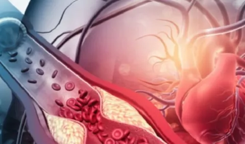 Enfermedad de las arterias coronarias