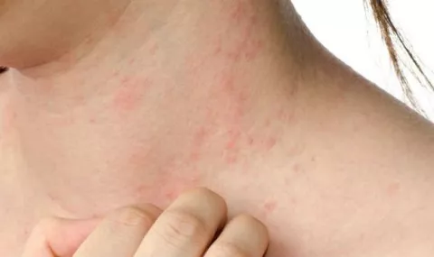 Estrés, su impacto en la dermatitis atópica 