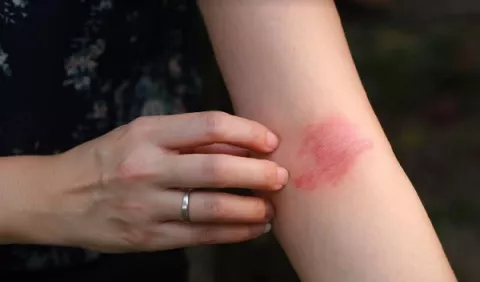 Dermatitis atópica en adultos