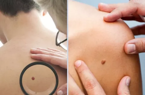 Melanoma, el tipo de cáncer de piel más grave