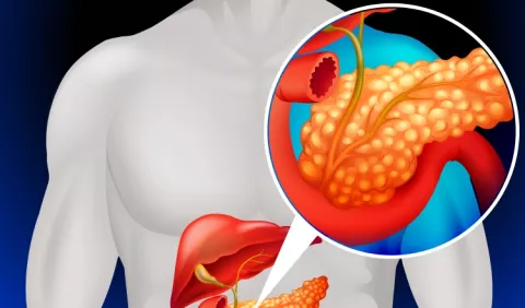 Altos niveles de insulina y el cáncer de páncreas 