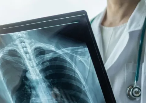 Cáncer de pulmón: El estigma asociado al tabaquismo