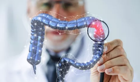 Cáncer de colon en adultos jóvenes: ¿Qué debe saber?