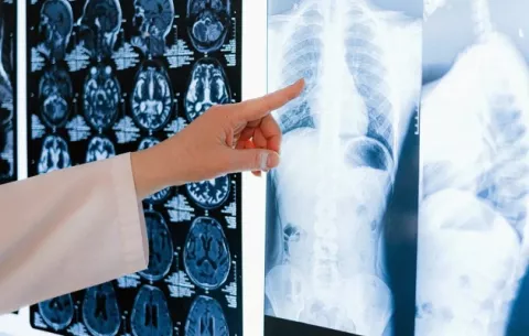 Cáncer de pulmón vuelve a ser el más común en el mundo 