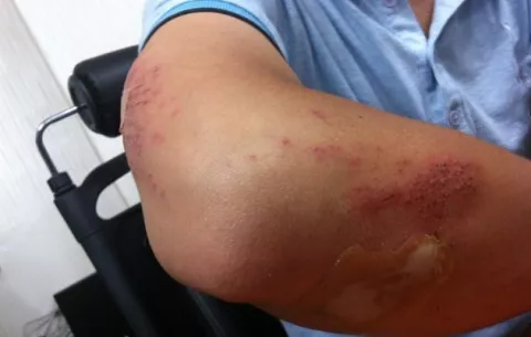 Día Mundial de la Hemofilia en medio una gran brecha en la atención 