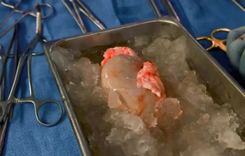 Una mujer en Estados Unidos recibe un riñón de cerdo