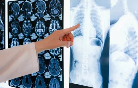 'Un paciente con cáncer de pulmón en etapa precoz se puede curar'