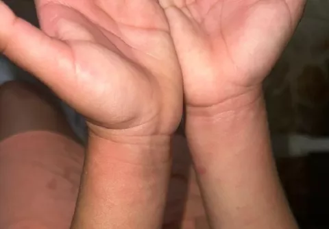 Por afección dermatológica suspenden clases en colegio 