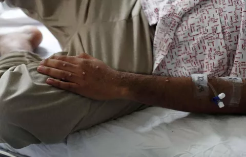 OMS: Expansión de mpox requiere respuesta unificada, pero sin entrar en pánico