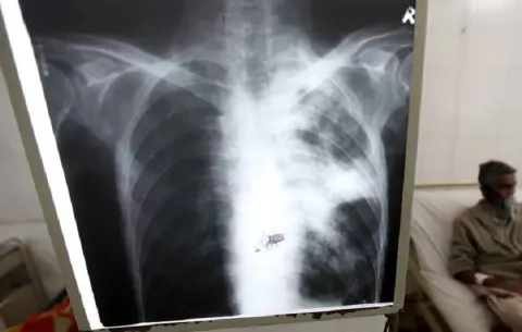 Tuberculosis supera a la covid-19 y es de nuevo la enfermedad infecciosa más mortal