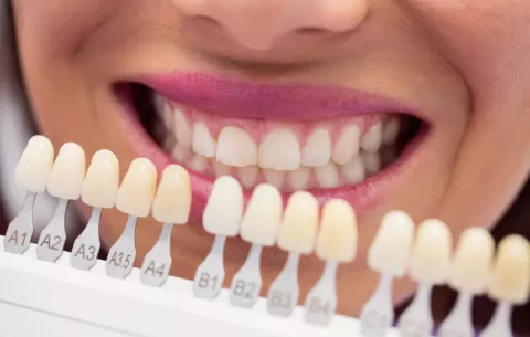 Natural 3D, la revolución de las carillas dentales