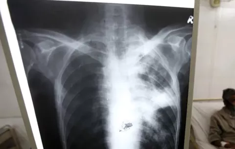 En Colón circula una cepa de la tuberculosis con alta transmisibilidad, responsable del 30% de los casos reportados